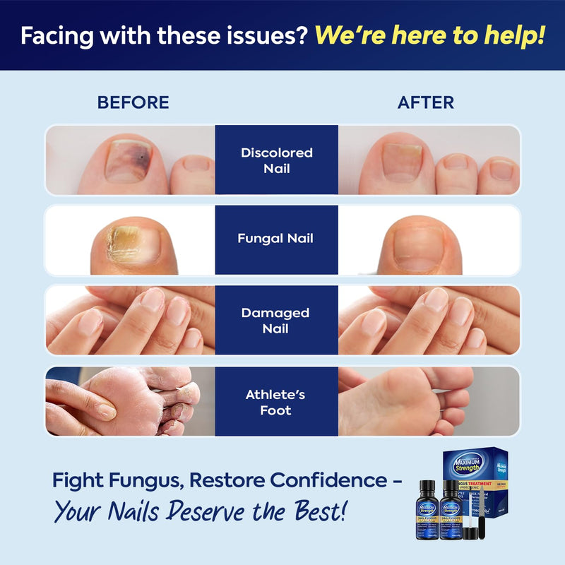 [Australia] - Toenail Fungus Treatment with 25% Undecylenic Acid, Toe Fungus Treatment for Toenail, Fungus Nail Treatment, Toenail Fungus Treatment Extra Strength, Fungal Nail Treatment for Athletes Foot - 2pcs 