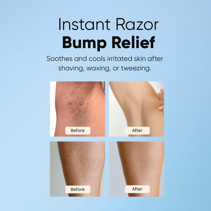 [Australia] - ESTETIST Razor Bump Solution Roll-On, Ingrown Hair & Razor Burn Care Serum, After Shave Roller for Bikini Area, Face, Neck, Underarm & Legs, Skin-Soothing Post Shave Care Original 