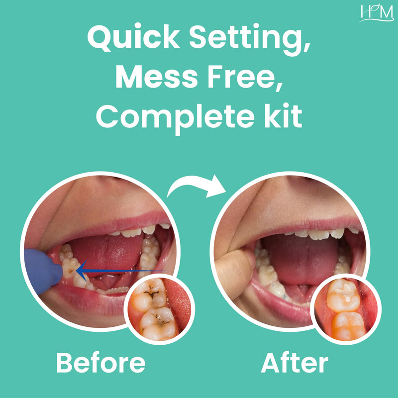 [Australia] - HM Zinc Oxide Eugenol Dental Cement Kit | Super Adhesive | Instant Tooth Repair, Cap, Crown & Bridge Filling | DIY, Self Curing, Sturdy & High Strength |Universal Shade| Emergency Dental Care | 1 Box 