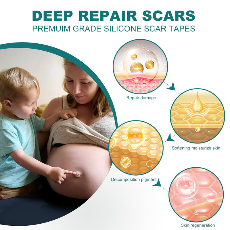 [Australia] - Silicone Scar Sheets (1.6"x 158" Roll-4M), Silicone Scar Tape for Scar Removal Treatment, Reusable Silicone Scar Strips for C-Section, Keloid, Burn, Acne, Surgical Scars 1.6"×158" 