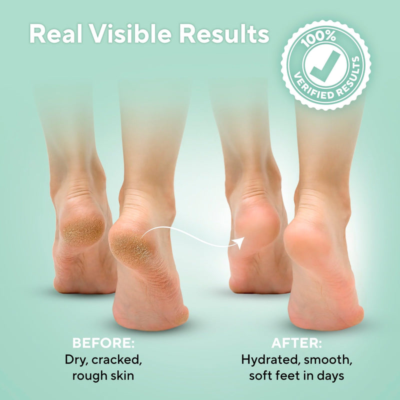 Lavinso Urea Cream 40 Percent for Feet with Maximum Strength - Foot Cream for Calluses and Dry Cracked Heels - Rough Skin Repair for Men and Women