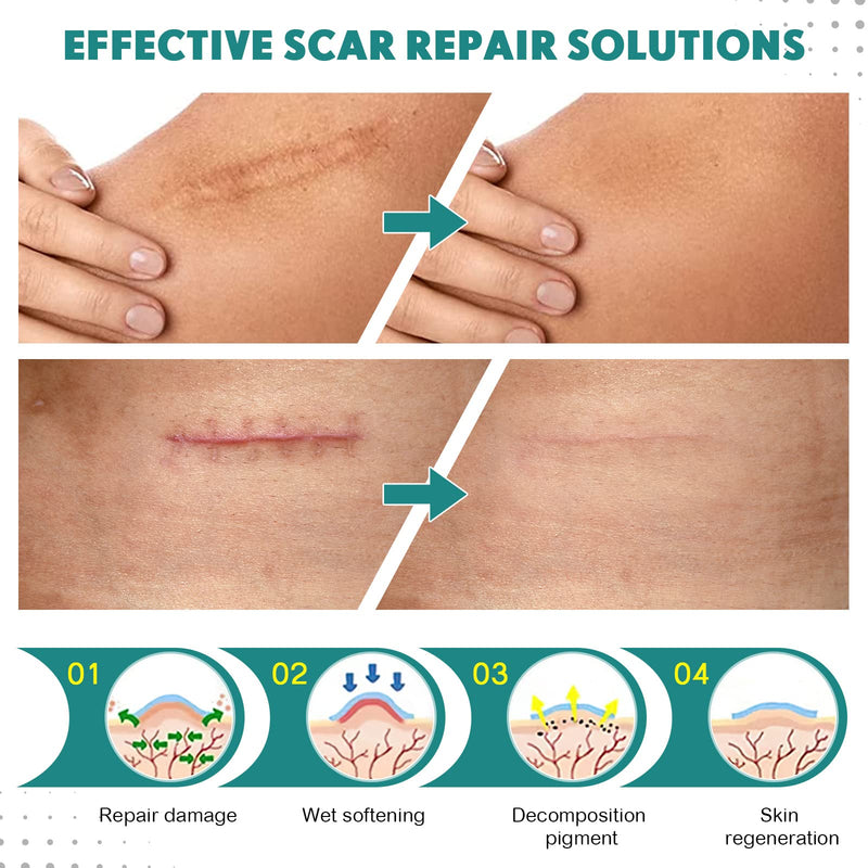 [Australia] - Silicone Scar Sheets, Silicone Scar Tape(1.6” x 120” Roll-3M), Scar Removal Away Strips for Surgical Scars, Keloid, C-Section, Burn et 120x1.6 Inch (Pack of 1) 