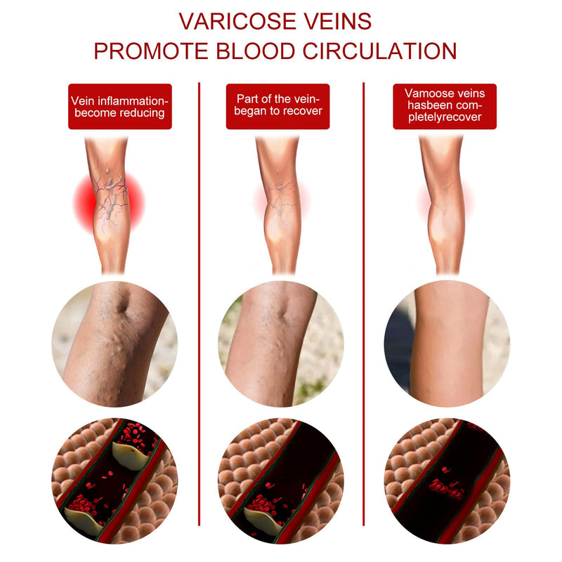 [Australia] - Grgowe Varicose Veins Cream, Varicose Veins Cream, Cream for Spider Veins, Active Veins, Anti-Varicose Veins Cream, Cream for Relieving and Preventing Varicose Veins, Improve Blood Circulation for Legs 