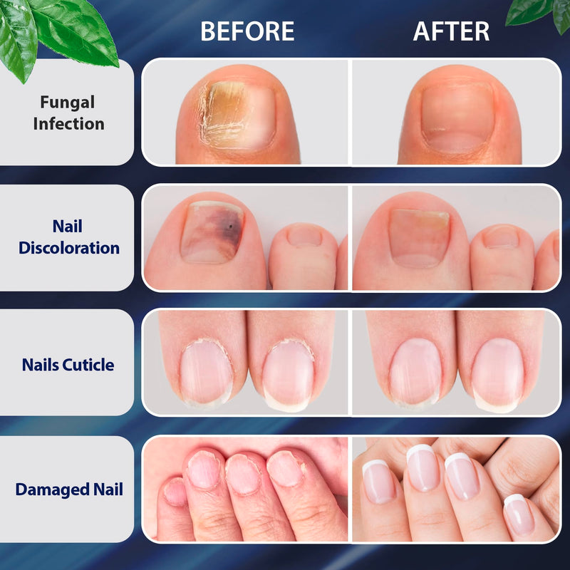 Tobcharm Toenail Fungus Treatment : Nail Fungus Treatment Extra Strength with Tea Tree Oil - Fast Acting Fungal Nail Solution with Undecylenic Acid for Toenails and Fingernails, 2Pack