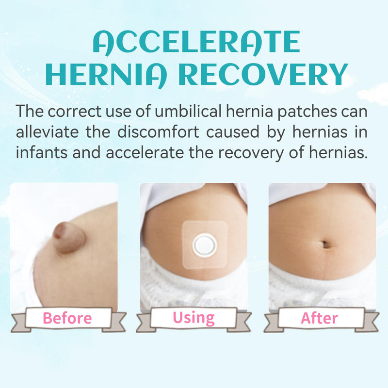 [Australia] - Baby Belly Navel Patches(15 Pieces), Hernia Patch,Belly Button Shaper with Waterproof Cotton Pads,Umbilical Hernia Belt Baby,Baby Belly Button wrap 8×8cm 8*8cm 