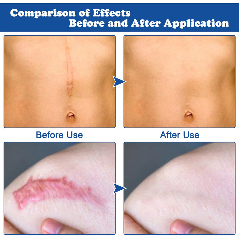 [Australia] - 2 sticks of scar ointment, scar gel, scar cream, scar gel, scar cream after surgery, scar gel after surgery, scar ointment after surgery, scar gel for children and adults, scar ointment after surgery 