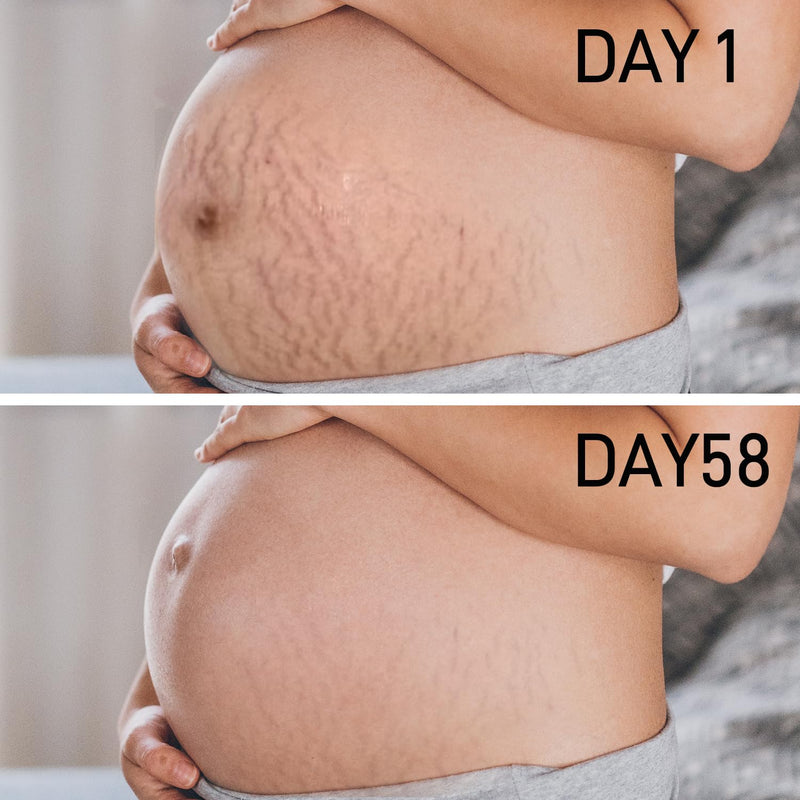 [Australia] - PEGO Stretch Mark Oil for Pregnancy, Maternity Body Oil for Stretch Mark Prevention & Reduction, Hydrating Skin Care, 5.41oz (Oil+Cream) Oil+Cream 
