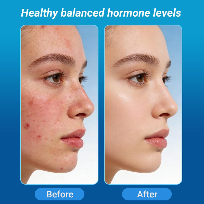 Hormonal Acne Supplement, Clear Skin Supplement with Zinc, Natural D Supplement - Skin Care Vitamins - Hormone Balance, Antioxidants - Gluten Free, Cruelty Free, 60 Capsules