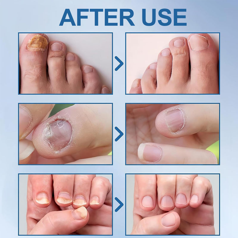 Extra Strength Toenail Fungus Treatment 1oz, Restore Yellow Nails | For Toenails & Fingernails, Gentle Non-Irritating, Precision Brush Applicator, Fast-Absorbing, Athlete's Foot Relief