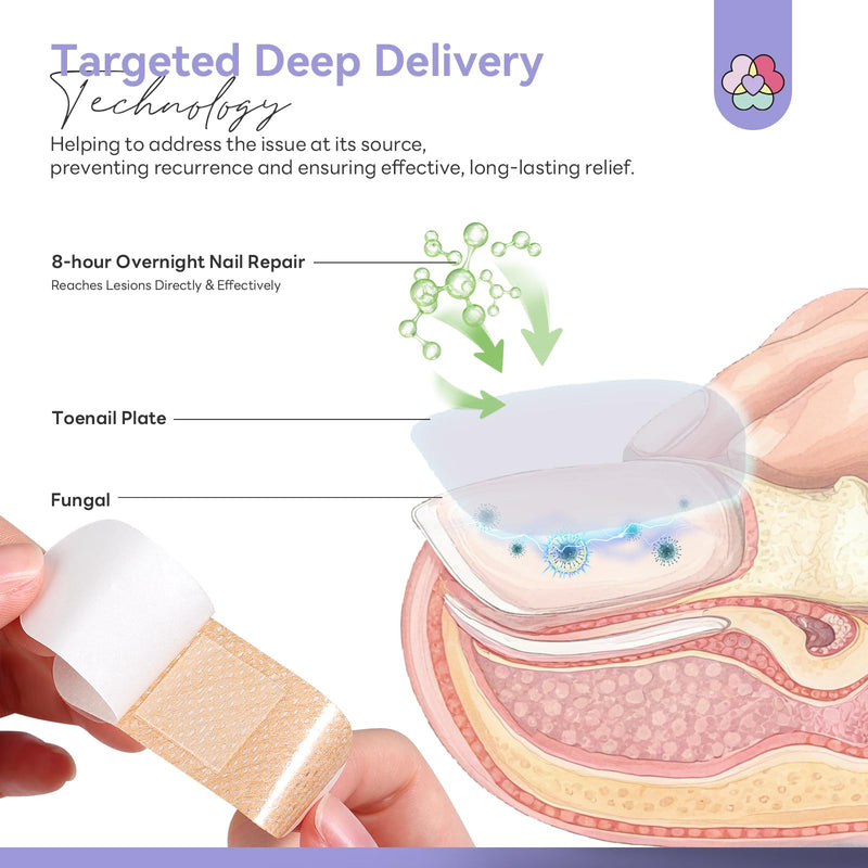SAVILAND Fungal Nail Patches 1% Tolnaftate for Overnight Nail Repair 32Pcs | FSA-HSA, 8H Deep Overnight Repair, Reduces Yellow & Thick Nails, Breathable Materials Adhere Securely, Damaged Toenail Care 32 Patch