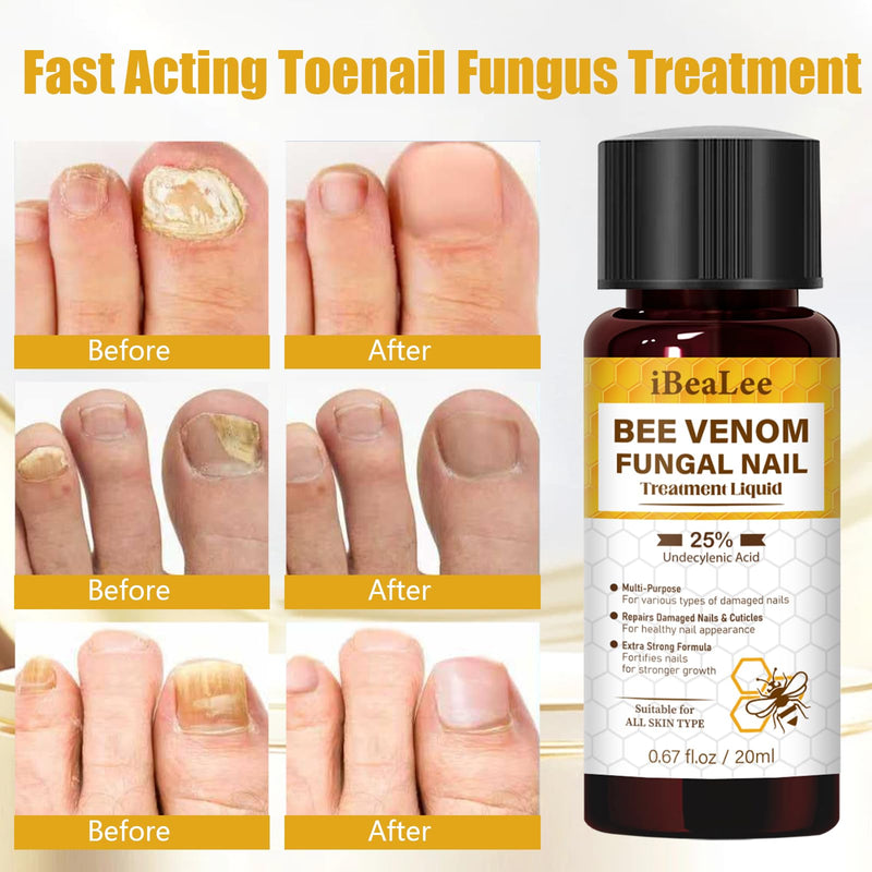 Toenail Treatment Extra Strength with 25% Undecylenic Acid for Yellow, Thick, Damaged, Discolored Nail -Y02