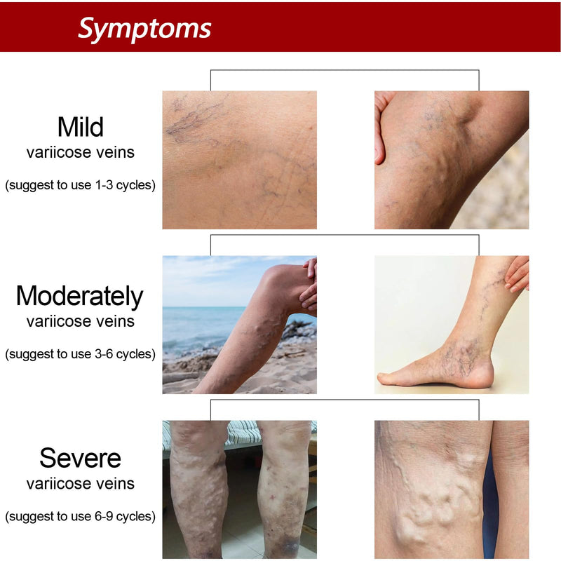 [Australia] - Grgowe Varicose Veins Cream, Varicose Veins Cream, Cream for Spider Veins, Active Veins, Anti-Varicose Veins Cream, Cream for Relieving and Preventing Varicose Veins, Improve Blood Circulation for Legs 