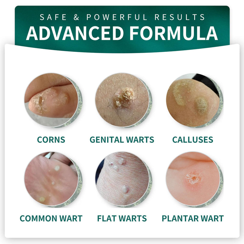 [Australia] - Wart Remover Liquid - 12% Wart Liquid with Salicylic Acid - Fast Acting Wart Freeze OffÔºåfor Warts, Plantar Wart, Genital Wart White 