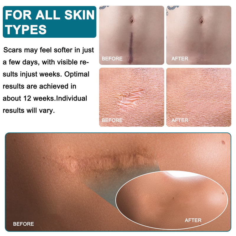 [Australia] - Silicone Scar Plaster, Professional for C-Section Scars, Surgery, Burns, Keloid, Acne and More, Drug Free, Silicone Scar Roller(4CMx300CM) 4CMx300CM 