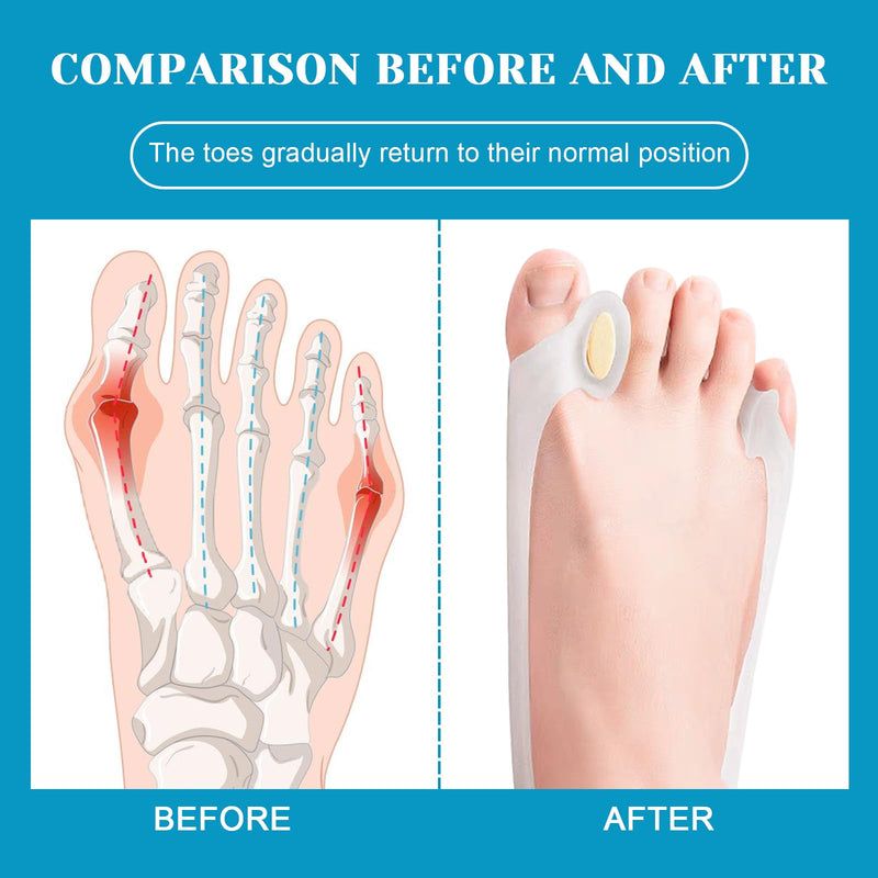 [Australia] - nailgeler 3 piece hallux valgus corrector set, silicone hallux valgus toe separator, hallux valgus training band, hallux valgus correction set for men and women 1 