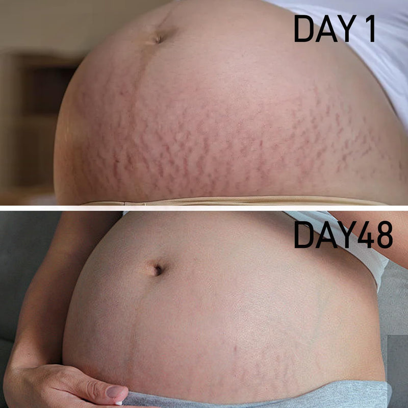 [Australia] - PEGO Stretch Mark Oil for Pregnancy, Maternity Body Oil for Stretch Mark Prevention & Reduction, Hydrating Skin Care, 5.41oz (Oil+Cream) Oil+Cream 