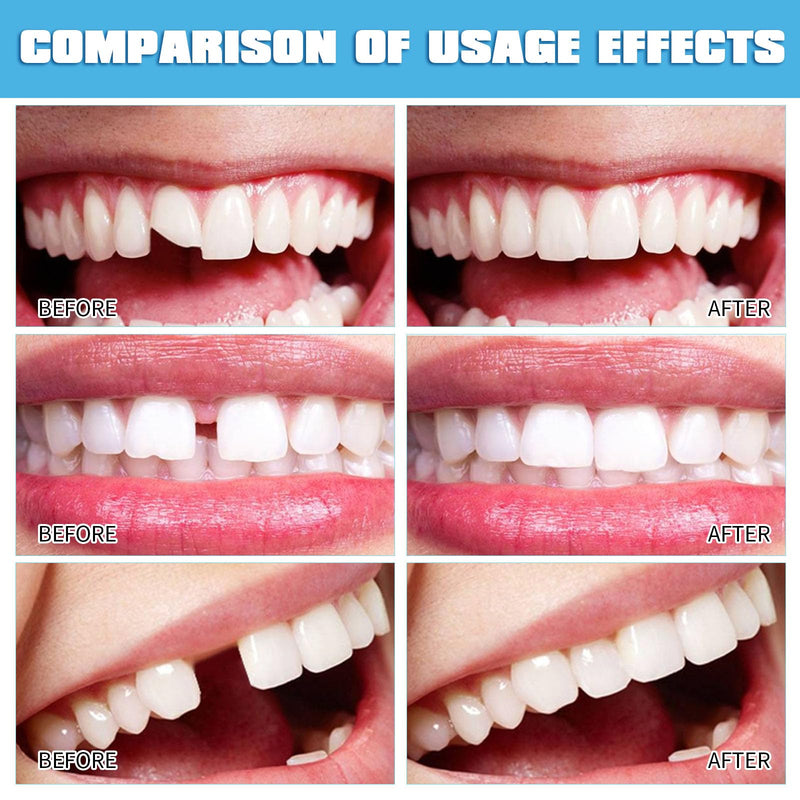 [Australia] - Clip-on teeth, 100 g dentures, temporary teeth, tooth repair set, do-it-yourself dentures, is suitable for temporarily repairing missing or damaged teeth. 
