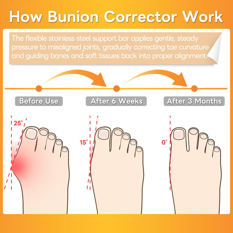 Bunion Corrector with 4 Flexible Stainless Steel Strips (2 on Each Side), Silicone Pads for Cushioning, Pain-Free Foot Condition Improvement, Wearable with Shoes,Washable
