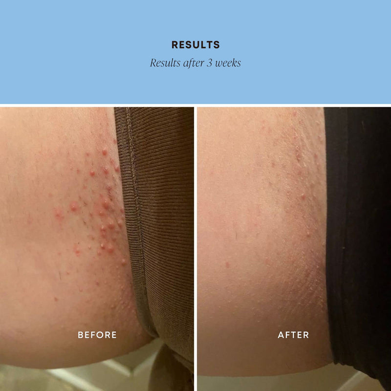 [Australia] - Bushbalm Ingrown Hair Exfoliating Scrub - Reduces Appearance of Ingrown Hairs and Underarm Bumps, Soothes Skin and Post Shave Redness - Nude, 236 ml Nude Scrub 