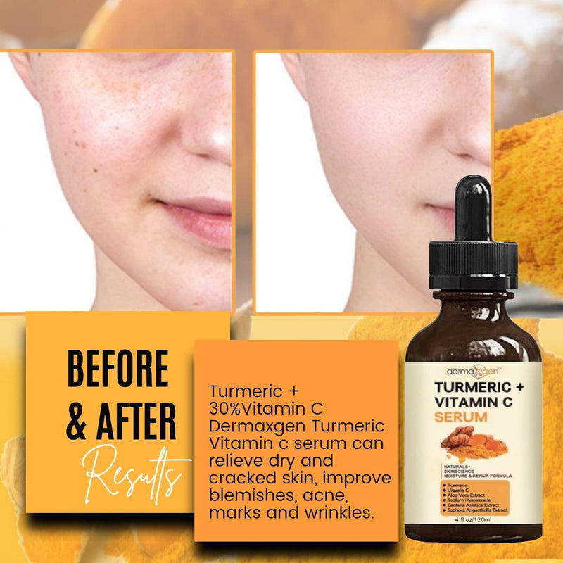 Turmeric Serum for Face + Glow-Boosting Vitamin C Serum –Organic Moisturizer for Acne, Dark Spots & Clear Skin– Boosts Hydration for Dry & Tired Skin – Anti-Aging Formula for Glowing Skin, 4 FL OZ 4 Fl Oz (Pack of 1)