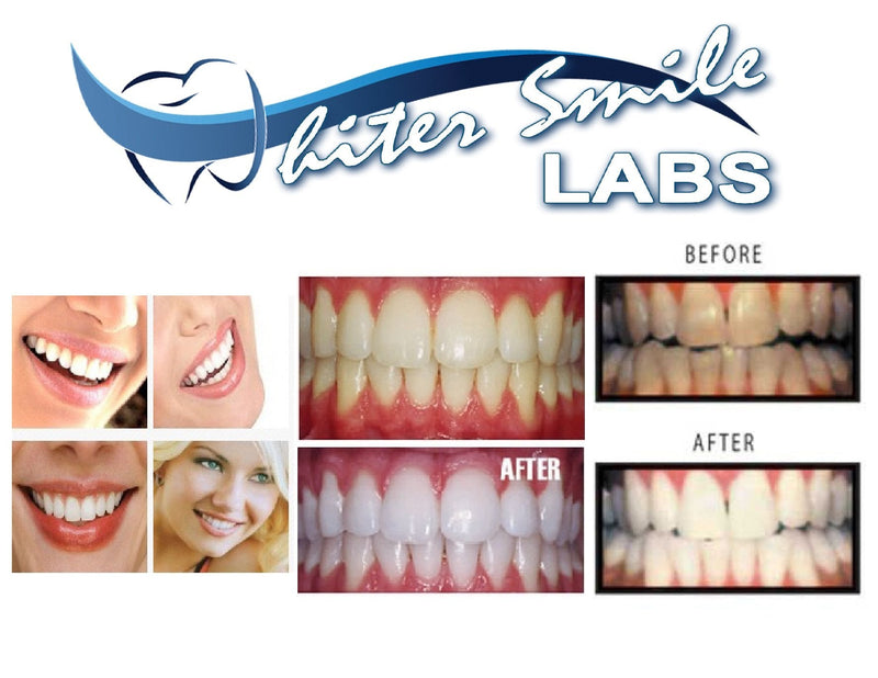 [Australia] - 5 XL 38% Teeth Whitening Gel Dentist Recommended High Intensity Carbamide Peroxide Pro Dental Lab Direct, Sensitivity Free, Sold by Dentists, Whiter Smile Labs Fast WHITENING Results 