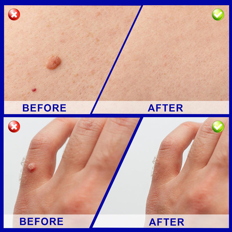 [Australia] - 30 ml skin tag remover, stalk warts removal quickly, skin tag remover kit, easy and convenient for most body parts, leaves the skin smooth 