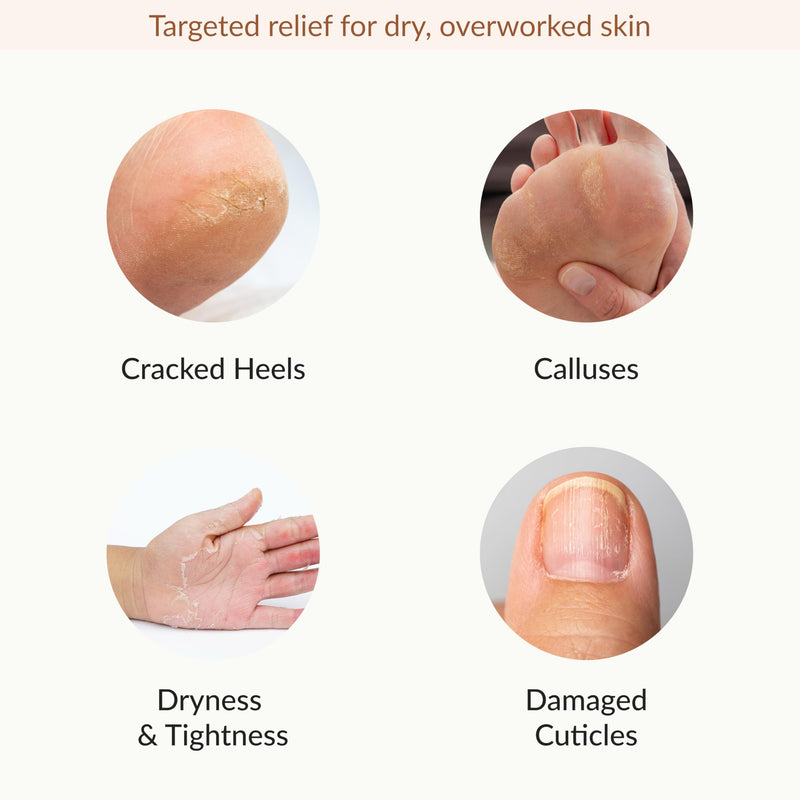 [Australia] - Epielle Hydrating & Moisturizing Hand & Foot Masks 12 Pairs, Relieve and Soften Dry Hands & Cracked Heels with Shea Butter & Sunflower Seed Oil, Korean Skin Care, Spa Set, Self Care Gifts for Women Hydrating & Moisturizing Gloves & Socks 