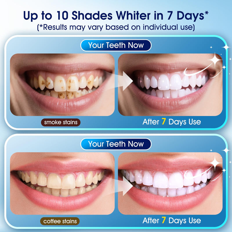 Teeth Whitening Kit – 3 Whitening Pens + 2 Desensitizing Pens – 35% Carbamide Peroxide – LED Light – Safe for Sensitive Teeth – 0.75 Fl Oz(Peppermint)