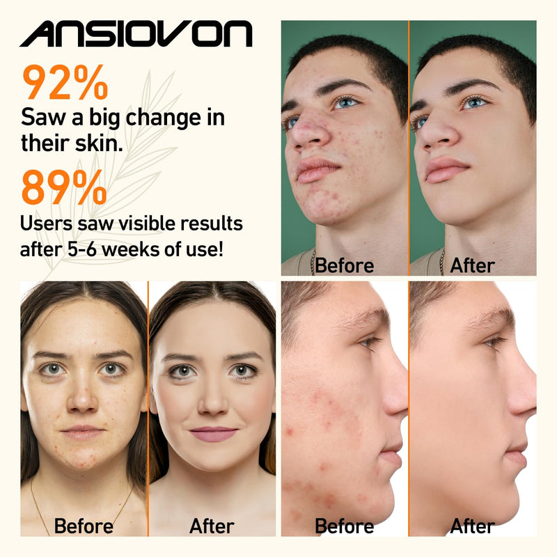 [Australia] - Blue Light Therapy Device for Acne Spot Treatment - LED Acne Blue Light Therapy Wand for Face 