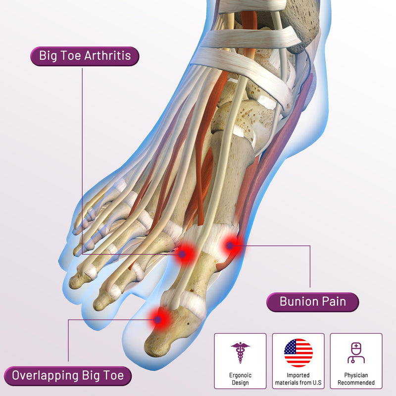 Bunion Corrector Sleeve, Breathable Bunion Big Toe Alignment Splint with Anti-Slip Heel Grip,4 Sizes,Extra Thick Gel Pads & Adjustable Straps for Hallux Valgus Comfort. XS: WOMEN 3-5 Beige