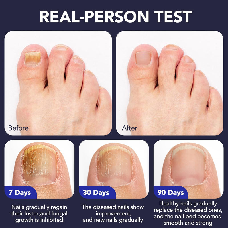 Toenail Fungus Pen - 25% Undecylenic Acid, Tea Tree Oil - Toenail Fungus Treatment Extra Strength for Toe Nail Repair Pen for Damaged Nails, Foot Fungal Nail Treatment for Fungi Funginail - 5pcs
