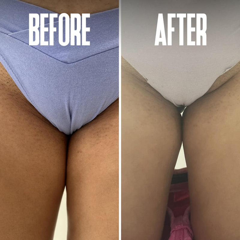 [Australia] - Prevent Ingrown Hairs and Razor Bumps with BHA & AHA Pads - Ingrown Hair Serum for Razor Burns, PFB Razor Bump Stopper Topicals Skin Care, Ingrown Hair Treatment for Bikini Area and Razor Bumps 50pads 