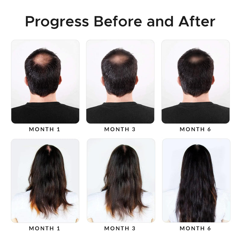 Minoxidil & Biotin Shampoo for Hair Growth - Enriched with Caffeine, Castor Oil & Onion - DHT Blocker for Thicker, Healthier Hair - Strengthening Formula for Men & Women