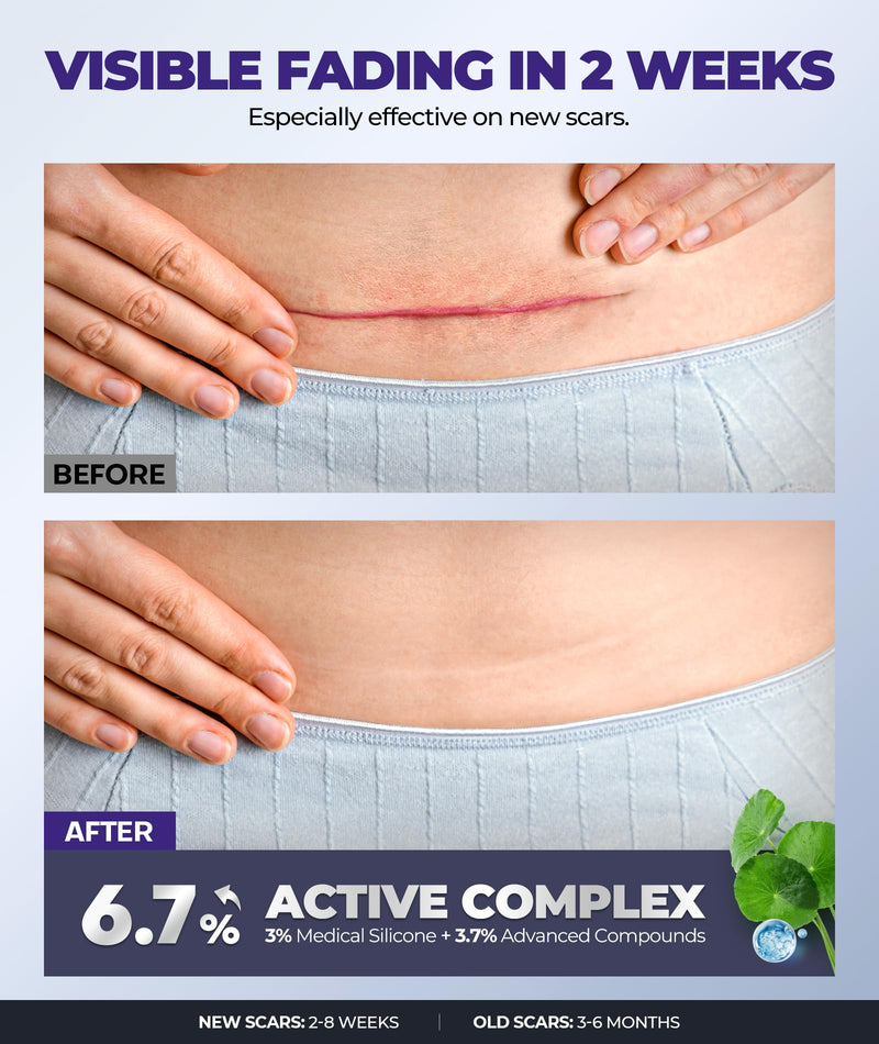 [Australia] - Silicone Scar Cream with 6.7% Active Ingredients, Scar Gel Visible in 2 Weeks, Moisturizing Scar Removal Clinically Show for Surgical, C-Section, Keloid, Acne & Burn Scars, Stretch Mark Cream(55ML) 