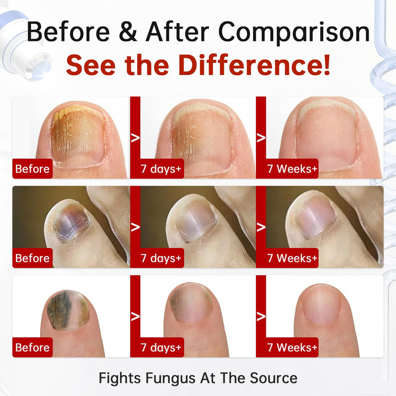 Toenail Fungus Treatment Extra Strength, 1% Tolnaftate Antifungal Fungal Nail Treatment, ToeNail Fungus Treatments For Thick Discolored Brittle Crumbling Nails, 0.51 fl oz (Pack of 1)