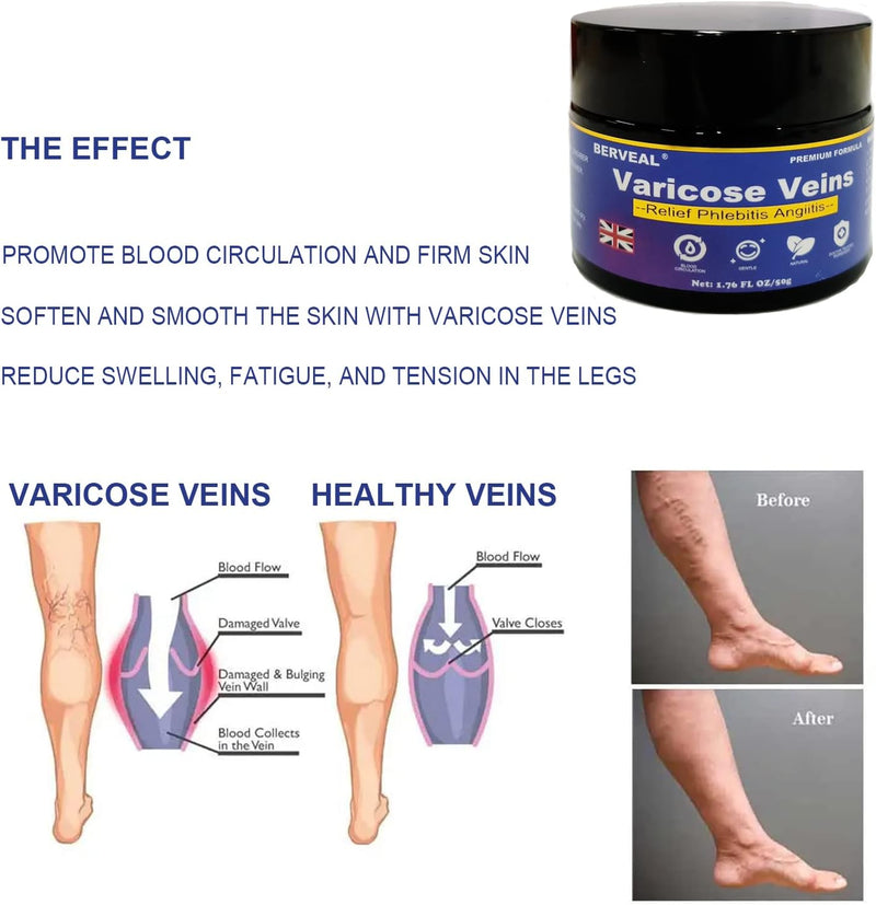 [Australia] - Varicose Veins Cream, Varicose Veins Cream, Cream for Spider Veins, Varicose Veins and Spider Veins Removal, Leg Care Cream, Gentle Leg Care, Improve Blood Circulation 