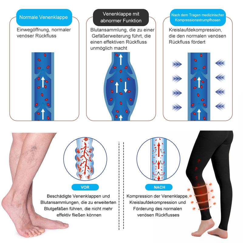 [Australia] - 2 pairs of medical compression stockings for women and men 20-30 mmHg, progressive support tights, opaque toe-free compression trousers class 2, suitable for varicose vein edema, TVT XXL 