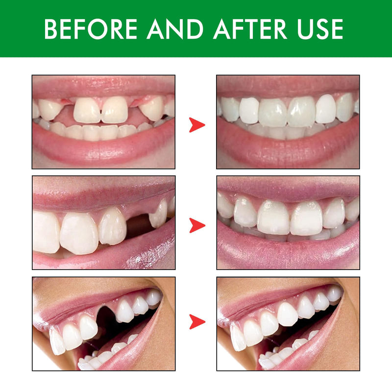 [Australia] - Tooth Repair Kit - 60g Temporary Fake Teeth Replacement Beads Kit with 3 Pieces Dental Tweezers Tools for Temporary Restoration of Missing & Broken Teeth Replacement Dentures 