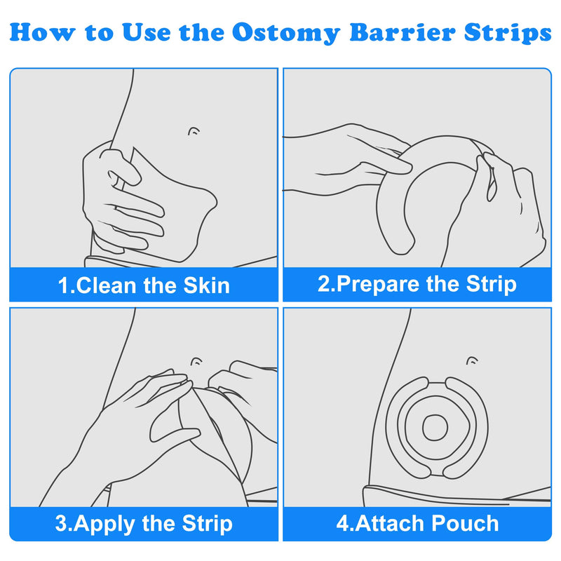 [Australia] - 20PCS Ostomy Barrier Strips Medical Grade Hydrocolloid Skin Barrier Tape for Colostomy, Ileostomy, Urostomy Bags Elastic Ostomy Rings Stoma Supplies Accessories 20PCS 