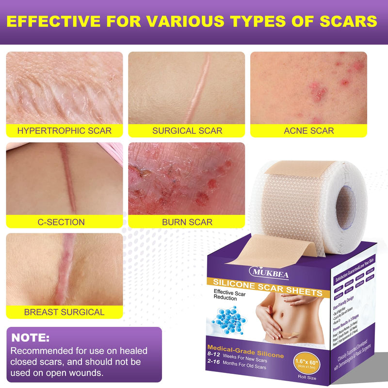 [Australia] - Silicone Scar Sheets, Silicone Scar Tape, Scar Tape for Keloid Bump Removal, Reusable Silicone Scar Strip for C-Section, Keloid, Surgery, Burns, Acne Scar et(1.6‚Äùx60‚ÄùRoll-1.5M) 1.5M (Pack of 1) 