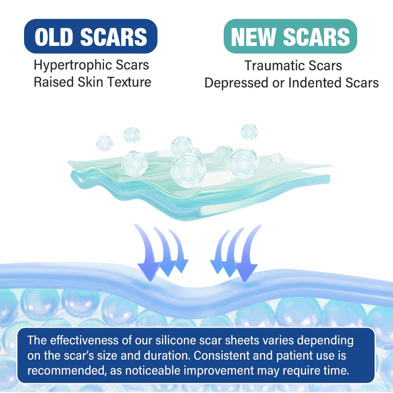 [Australia] - Silicone Scar Sheets,Silicone Scar Tape(1.6"x 158" Roll-4 meters),Silicone Scar Sheets for Surgical Scars,Keloid Bump Removal,Scar Tape for Surgical,C-Section,Tummy Tuck,Keloid Scars 