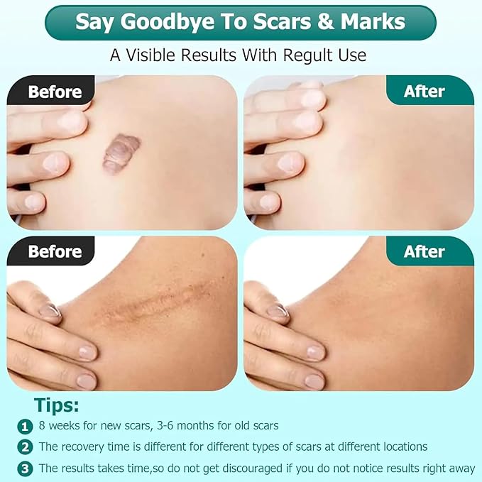 Silicone Scar Cream Scar Gel - Advanced Scar Gel Scar Treatment for Stretch Marks Removal, Old & New Scars, Surgical Scars, Burns, Acne, C-Section, Keloid Scar Treatment for Women & Men, 1.76Oz
