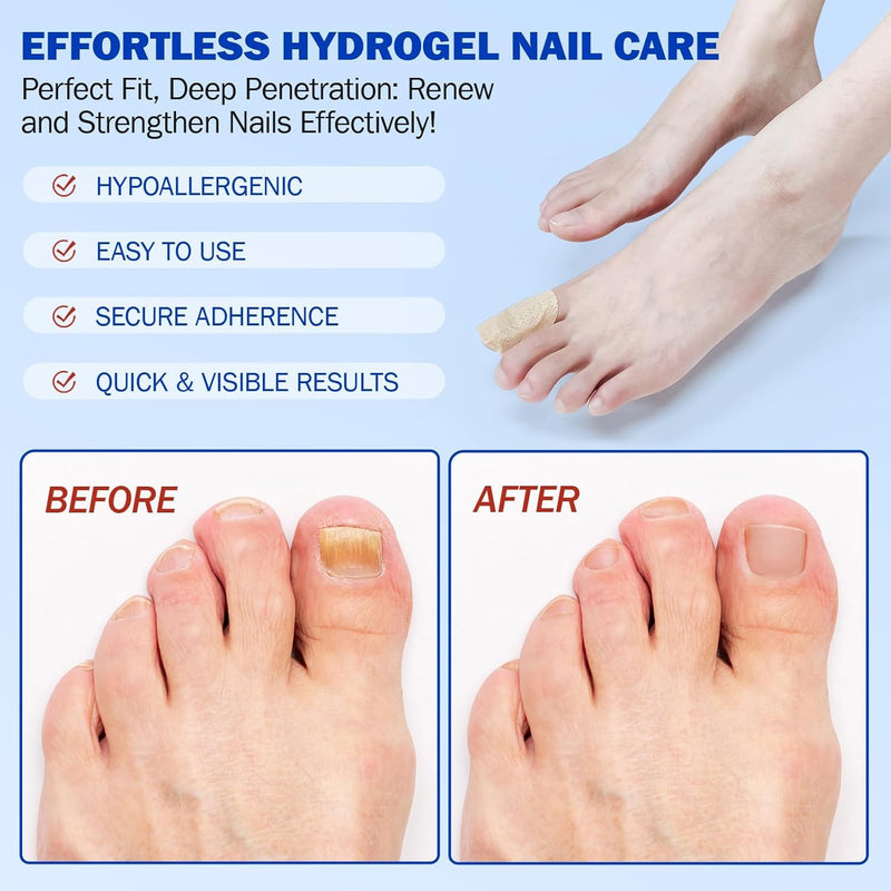 Nail Patches, Nail Patches for Toenails, Nail Treatment Patches Extra Strength, Extra Strong 8-Hour Repair Nail Plasters, Overnight Toe Nail Care Repair for Damaged Nails 4.04 Ounce (Pack of 1)