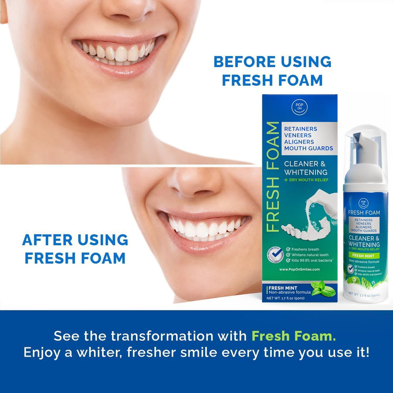 [Australia] - Retainer Cleaner Foam for Invisalign, Aligner Cleaner Whitening Foam for Mouth Guard Night Guard Veneers, Whitens Teeth, Freshens & Fights Bad Breath, 3% Hydrogen Peroxide, Mint - 50ml 1.7 Fl Oz (Pack of 1) 