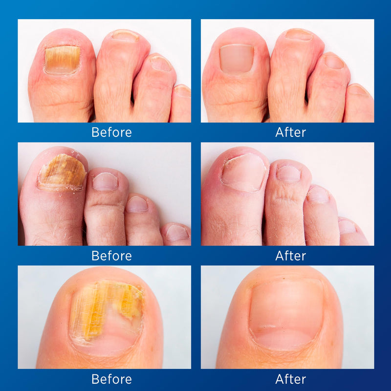 Toenail Fungus Treatment Extra Strength - Nail Fungus Treatment For Toenail Extra Strength - Nighttime Nail Patches & Nail Treatment Liquid Set (32patches+15ml) 32 PCS Medium Patches + 15mL Liquid