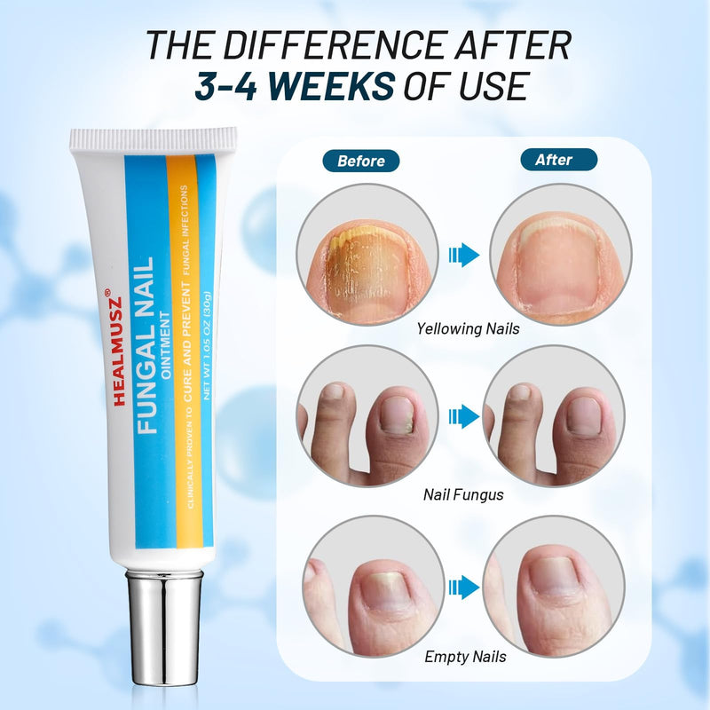 Toenail Fungus Treatment Extra Strength, AntiFungal Ointment for Ingrown, Yellow, Discolored and Damaged Nails, Gentle & Effective.