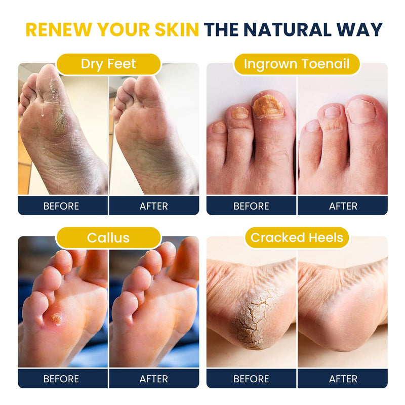 [Australia] - Citrus Detox Foot Soak with Epsom Salts Tea Tree Oil Foot Balm/ Moisturizer For Dry Cracked Feet - Instantly Hydrates & Soothes Irritated Skin & Athletes Foot 