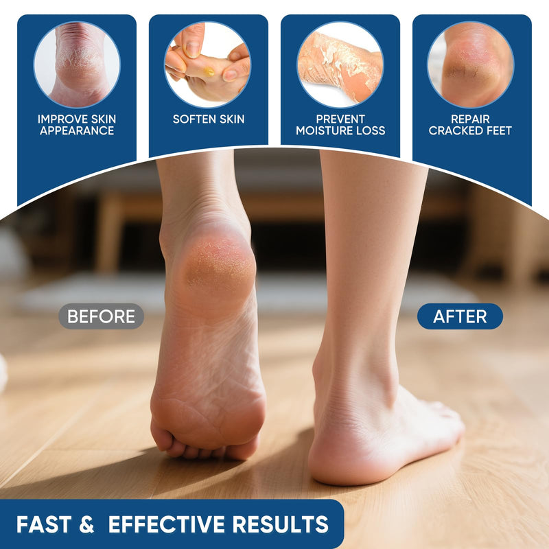 Urea Cream 40 Percent with 2% Salicylic Acid, Urea Cream 40 Percent for Feet Maximum Strength, Foot & Hand Cream for Dry Cracked Heels, Callus Softener for Rough Thick Skin, 5.29 oz (2 PCS) 2P
