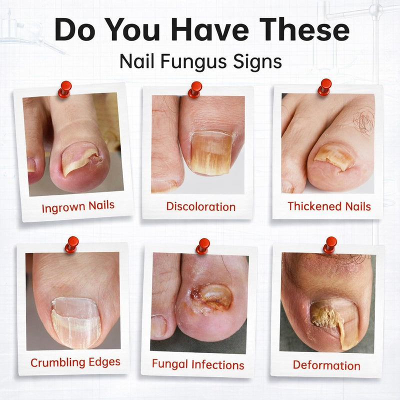 Toenail Fungus Treatment Extra Strength, 1% Tolnaftate Antifungal Fungal Nail Treatment, ToeNail Fungus Treatments For Thick Discolored Brittle Crumbling Nails, 0.51 fl oz (Pack of 1)