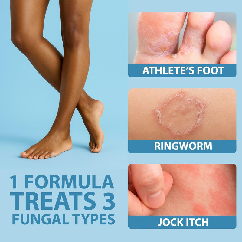 Curist Terbinafine Cream Antifungal 1oz (30g) Foot Fungus Treatment 1% - Anti Fungal Foot Care, Ring Worm, & Jock Itch Treatment - Athlete's Foot Cream Terbinafine Hydrochloride